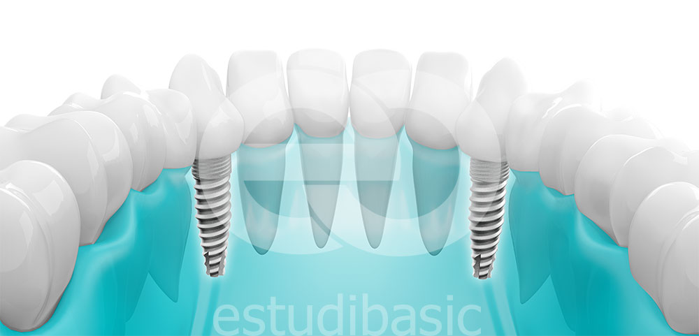  estudibasic-render-implantes-dentales-3d